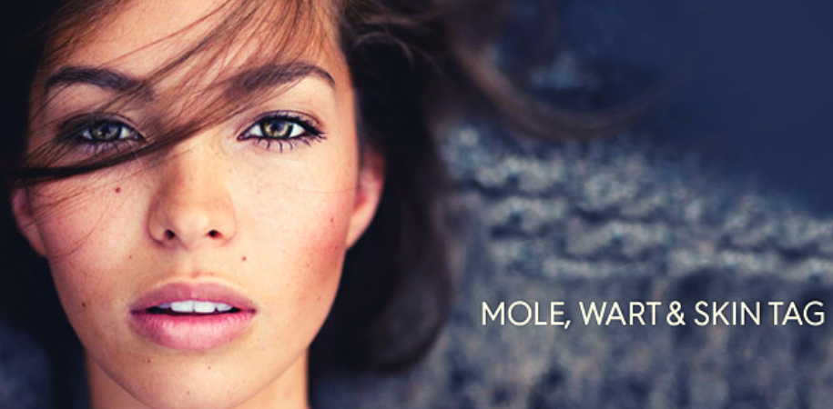 How to Remove Moles & Warts Permanently